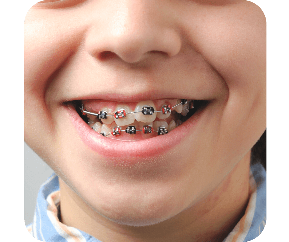 Early Orthodontic Treatment | The McLean Orthodontist